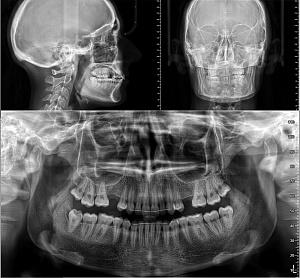 Стоматологичекий томограф NewTom Giano HR Professional (16x18) с цефалостатом - Фото 7