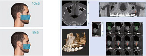Стоматологический томограф NewTom 2D/3D GO (10x10) - Фото 3