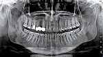 Стоматологический томограф NewTom 2D/3D GO (10x10) с цефалостатом - Фото 5