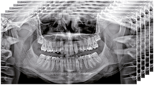 Стоматологический томограф NewTom 2D/3D GO (10x10) с цефалостатом - Фото 6